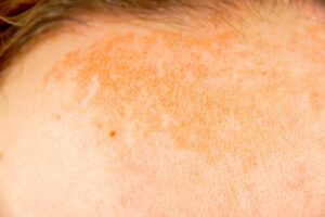 hyperpigmentation on forehead on skin