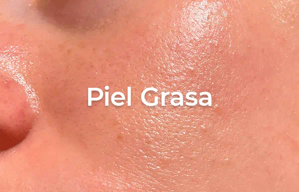 piel grasa